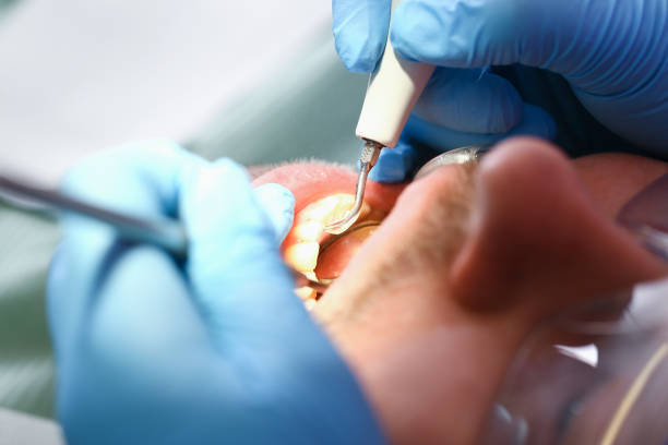 Best Emergency Dental Extractions in Elburn, IL